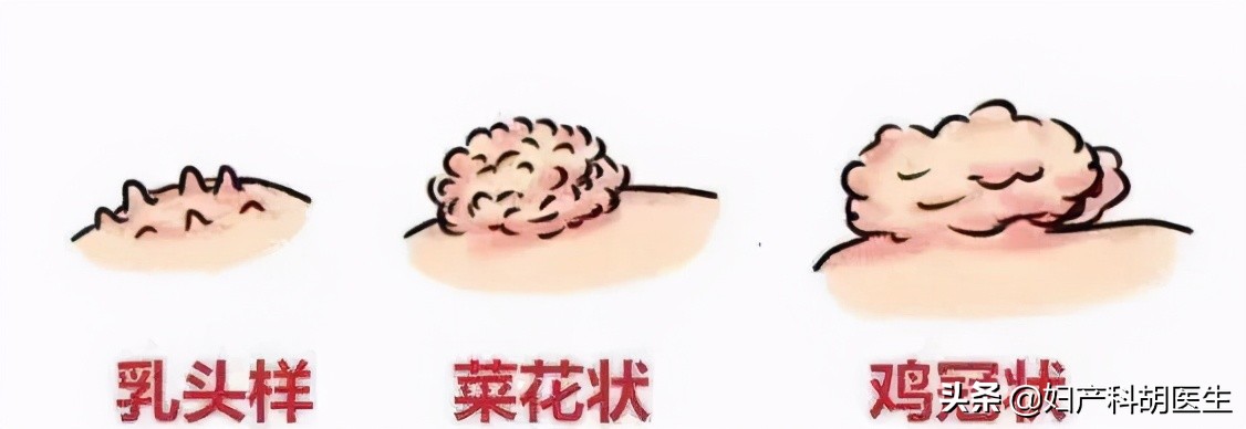 辟谣：孩子肯定不会得尖锐湿疣吗？医生说，这些细节别疏忽