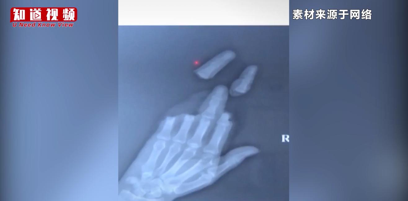 放风筝手指被人割断,放风筝手被割断