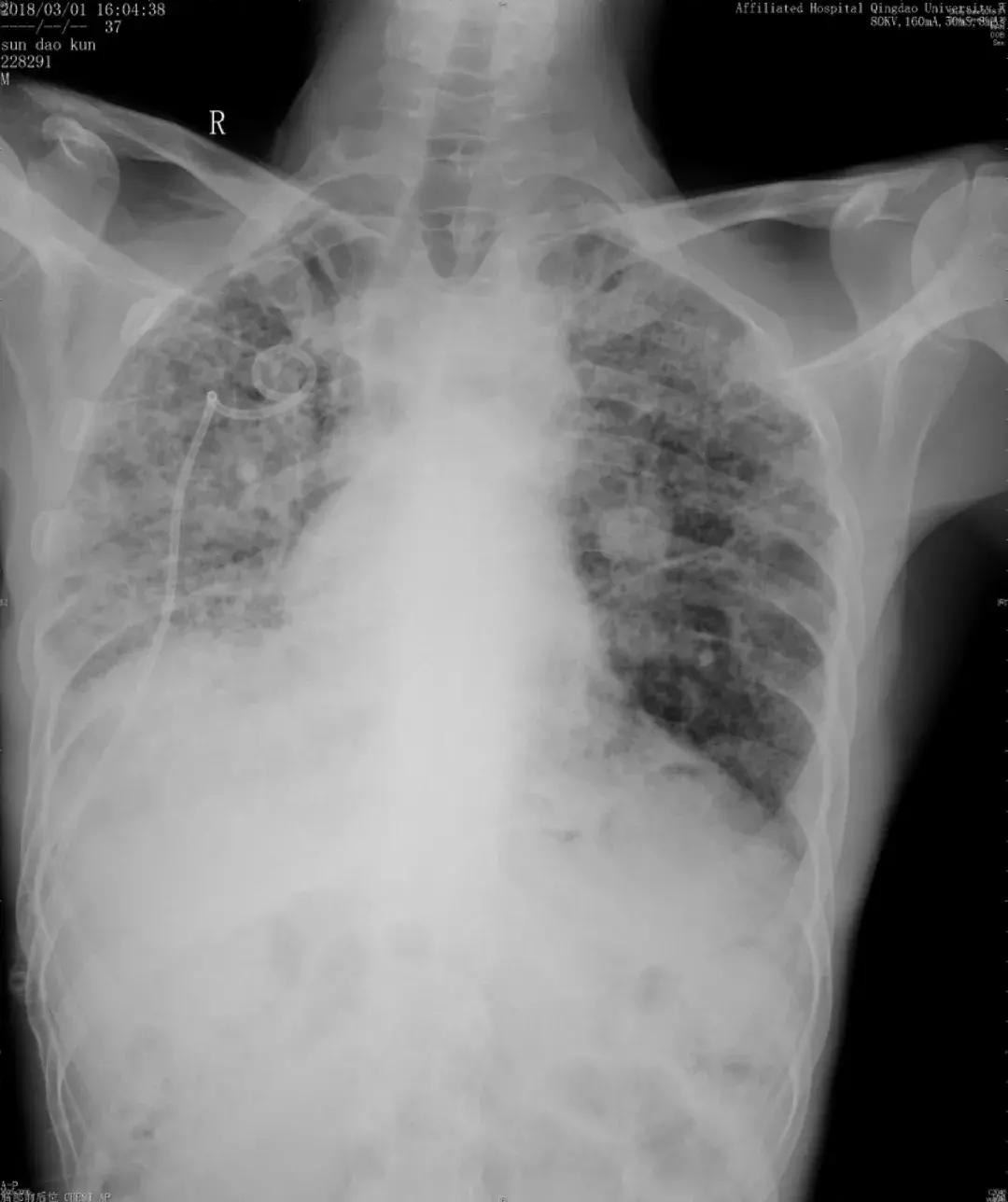 肺纤维化病例,肺纤维化手指甲发紫还能活多久