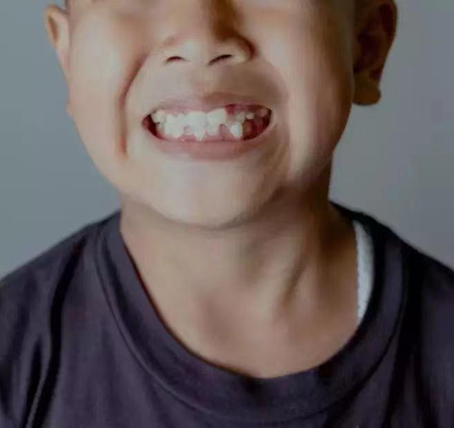 错过牙齿矫正时机,儿童牙齿矫正的3个黄金时期