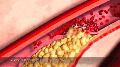 治疗冠心病心绞痛的四种常备药,心绞痛硝酸酯类药物有哪些