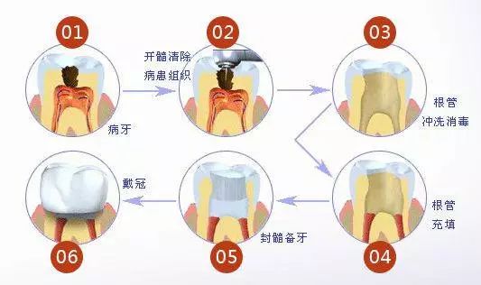 根管治疗后牙齿劈裂怎么办最好,牙齿戴冠还会劈裂