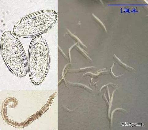 孩子屁股痛有白色虫子,小孩屁股痒痛有白色虫