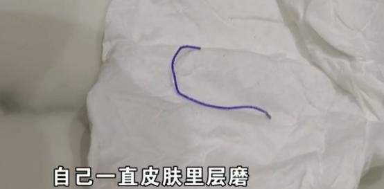 脸部填充手术案例,开腹手术美容线线头露出来怎么办