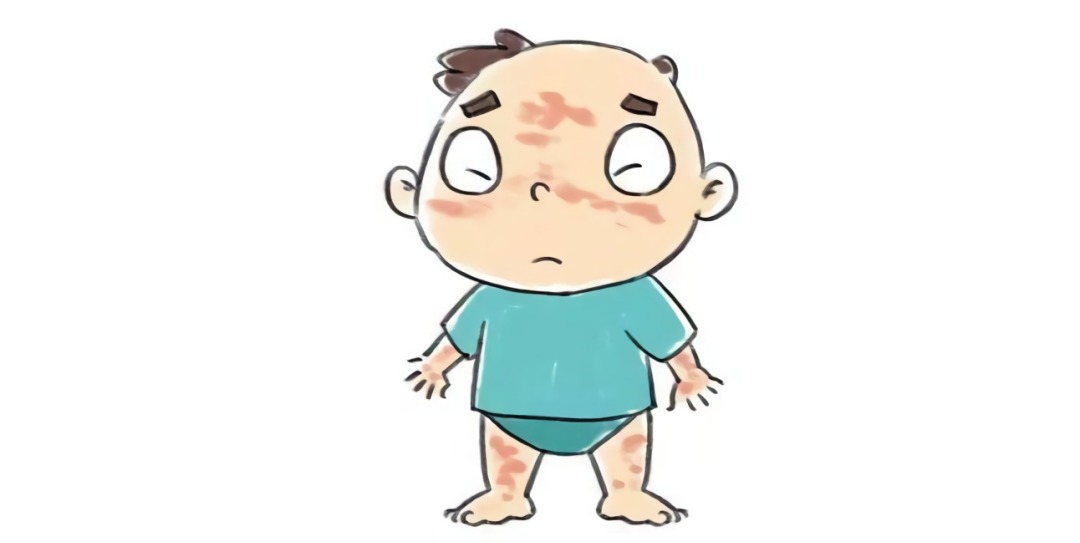 紫癜知识|过敏性紫癜的辅助检查(21)