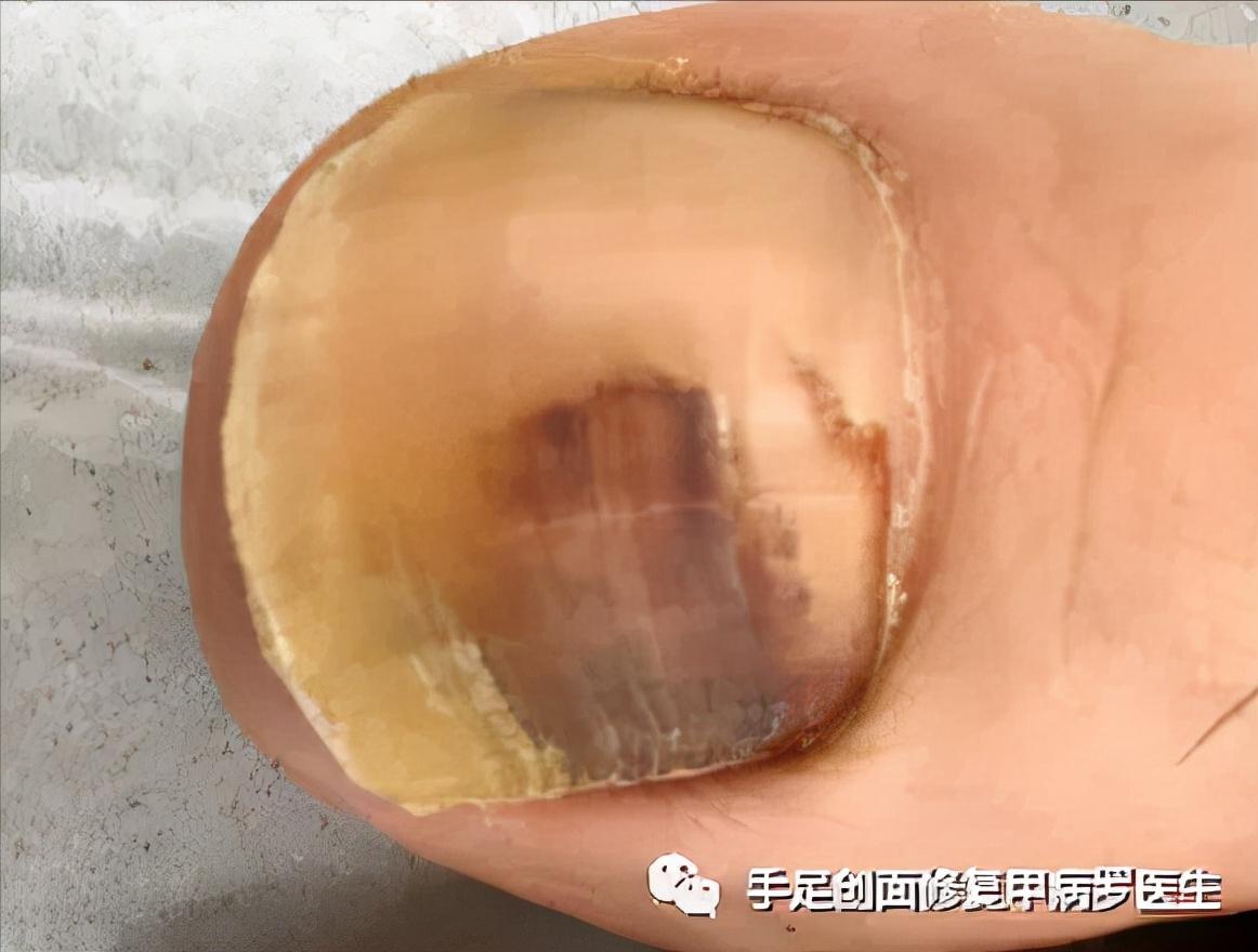 甲下积血放血后如何止血,甲下积血怎么办