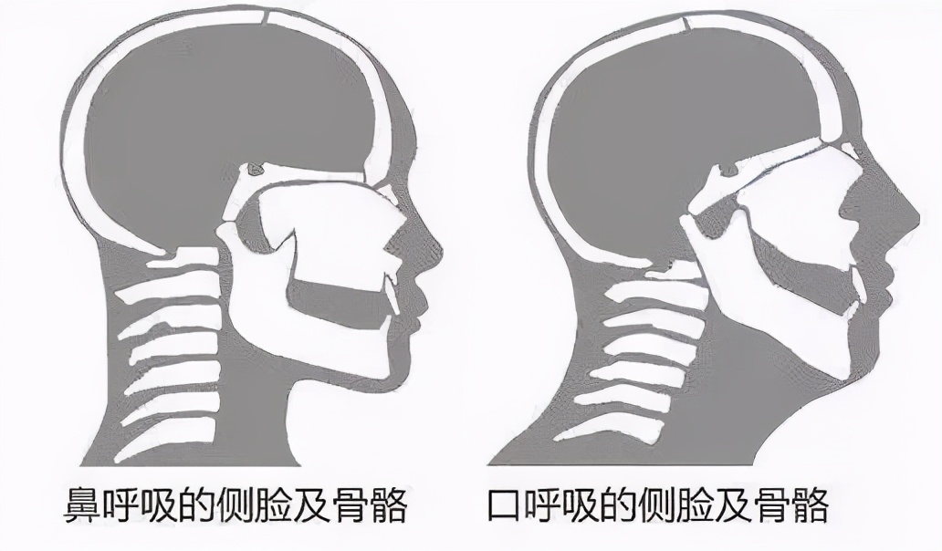 侧颜很难看是因为什么,侧颜不好看怎么修