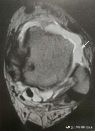 小孩脚踝麻麻的感觉怎么了,小孩常见的脚踝问题