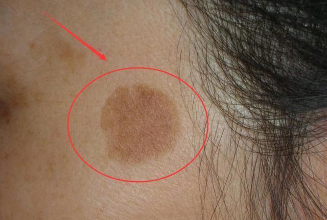 生活小妙招祛老年斑,生活小妙招去脸上的老年斑