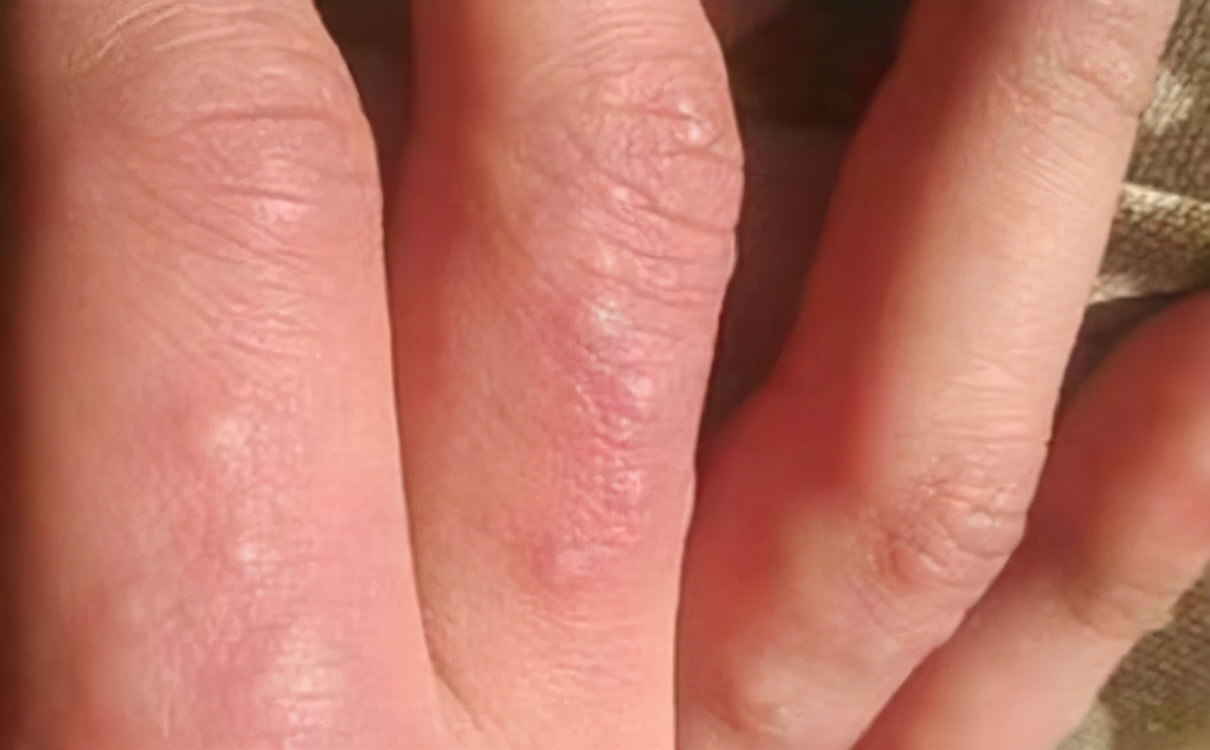 脚趾缝里面长个黄色水泡超级痒,脚趾缝长水泡脚趾缝糜烂奇痒无比