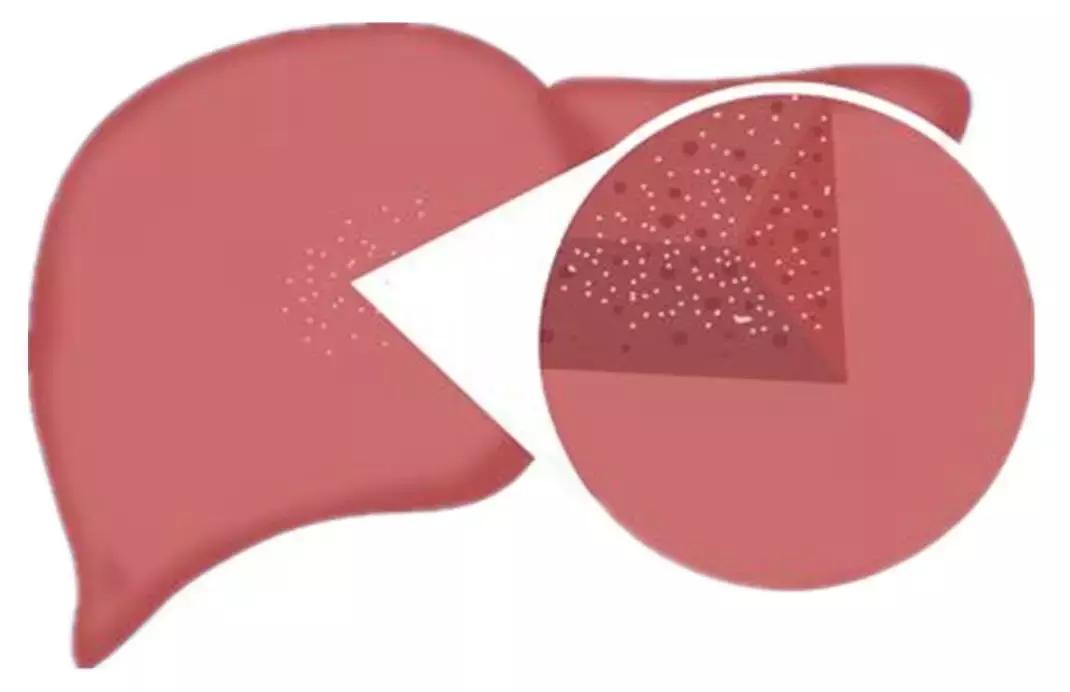 肝脏检查指标分析,肝脏检查都有哪些