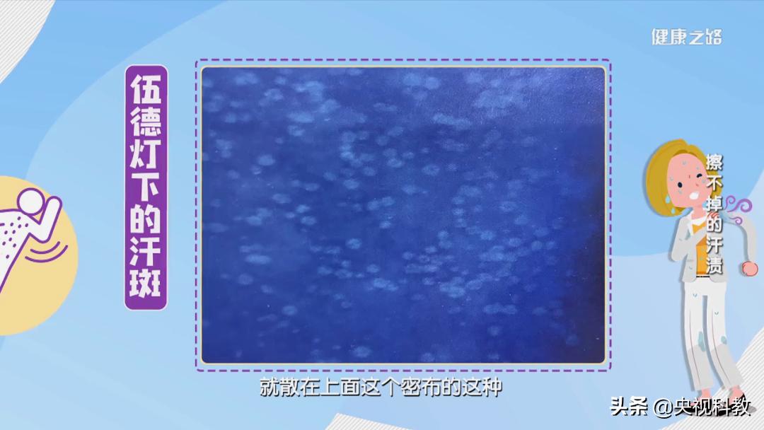 汗斑患病原因,汗斑看什么科