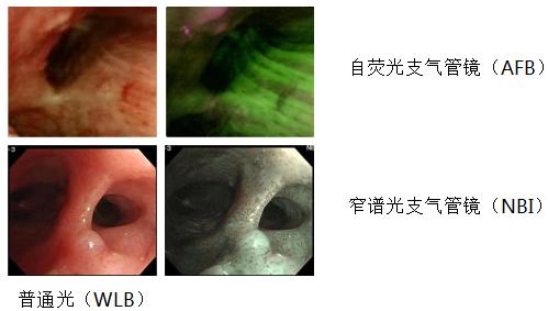 小细胞肺癌的气管镜介入治疗,导航支气管镜在肺癌诊断中的应用