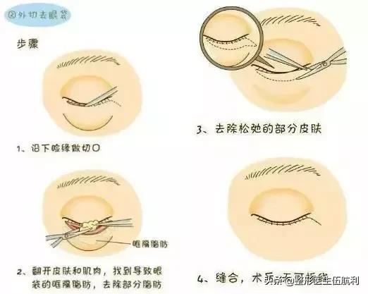 眼睛小应该做哪些眼综合手术,眼睛不对称怎么矫正医美