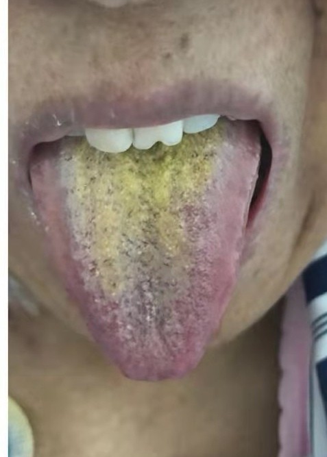 癌症晚期的中草药治疗方法,治疗癌症晚期的民间好医生