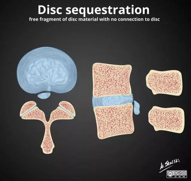 椎间盘脱出和突出片子怎么看,椎间盘膨出的鉴别诊断