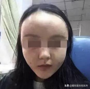 自体脂肪填充量有标准吗,自体脂肪填多了可以取出吗