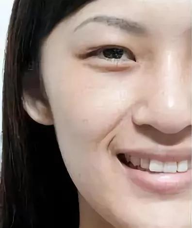 韦敏科普丨哪些原因会导致法令纹出现