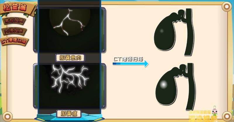 胆囊息肉还是胆囊癌?该如何确诊?动漫解密胆囊息肉检查那些坑