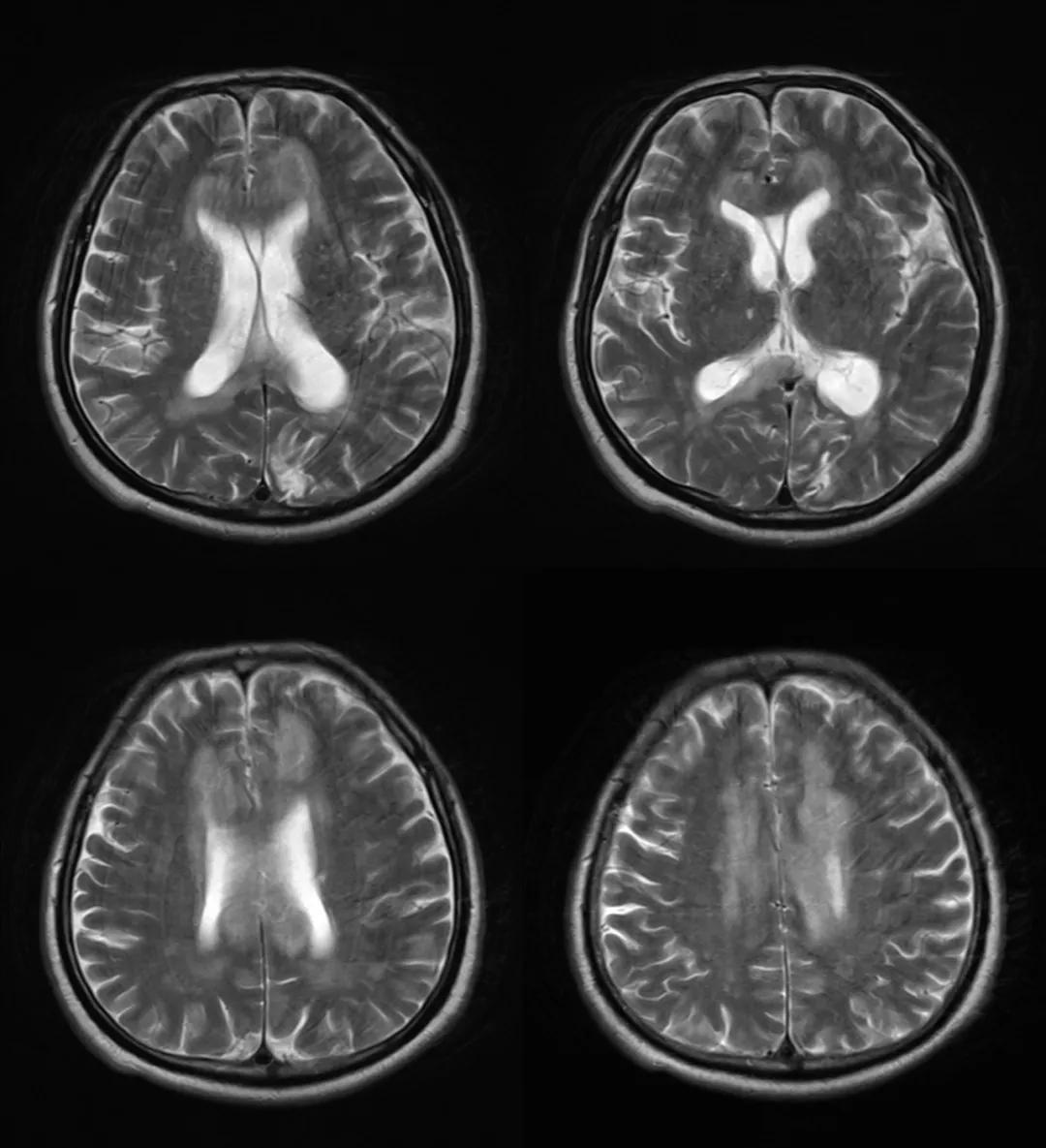 胼胝体有什么症状,胼胝体形态较小可以治疗吗