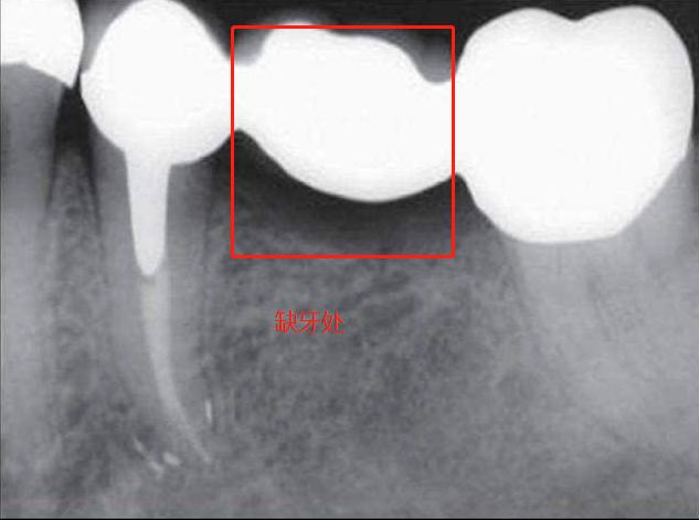 单颗牙缺失的修复方法,单颗牙缺失最好办法