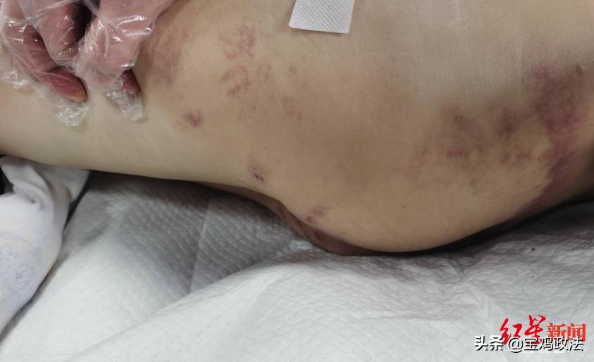 12岁女孩被继母虐待致脑梗死,女童疑遭继母虐待身亡