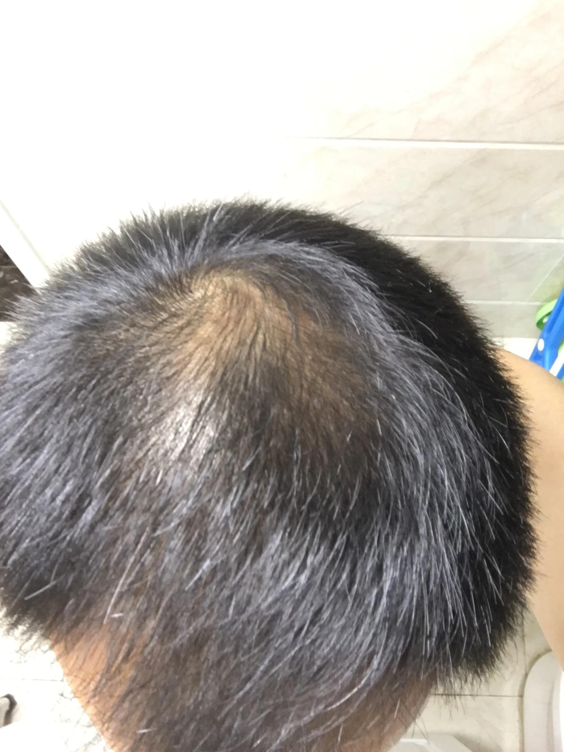 脂溢性脱发的治疗费用,脂溢性脱发的治疗方式