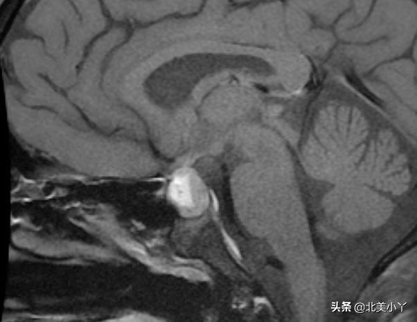 小丫说医｜一类影响全身的特殊脑瘤——“蝶鞍邂逅瘤”