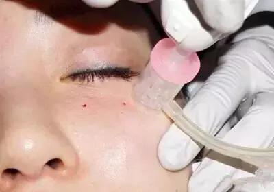 注射水光针为什么皮肤油亮,注射水光后皮肤干