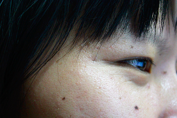 眼部周围长了小痘痘该怎么去除,眼部出现小颗粒痘是怎么回事