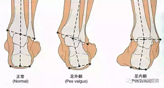 崴脚的预防和治疗,医生分享案例崴脚的科学治疗