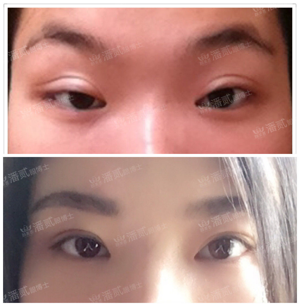 开外眼角结膜充血水肿怎么办,眼睛开外眼角有后遗症吗