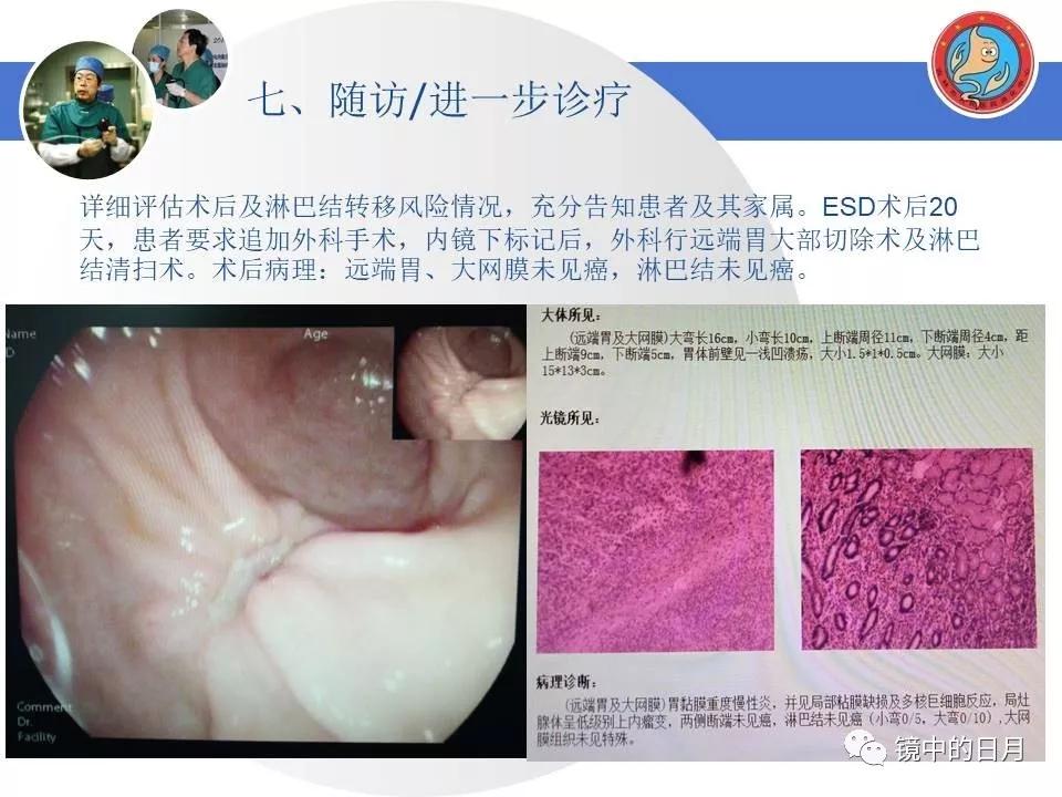 低分化胃癌早期时候做内镜手术吗,早期胃癌内镜手术后追加外科手术