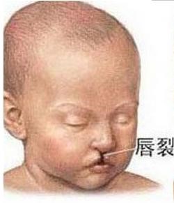 二维能看出胎儿唇腭裂吗,炒菜油烟导致胎儿唇腭裂