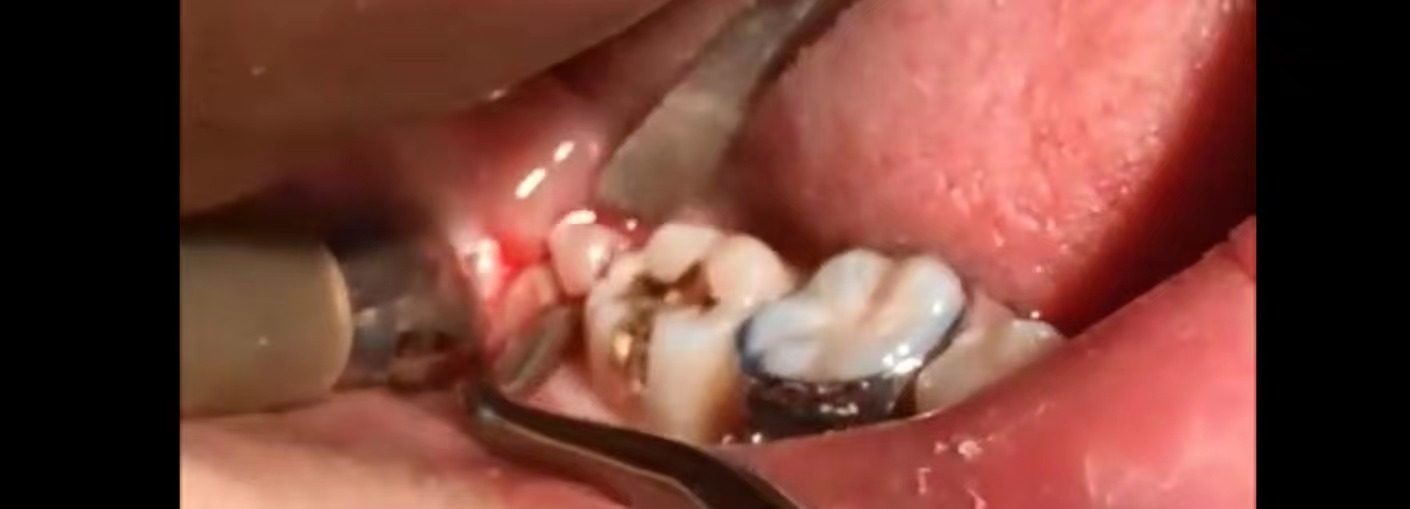 下颌阻生智齿不拔除有危险吗,不阻生智齿拔除