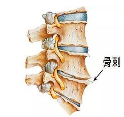 医生讲贴膏药可以治愈骨病,药品的宣传可以消除骨刺是真的吗