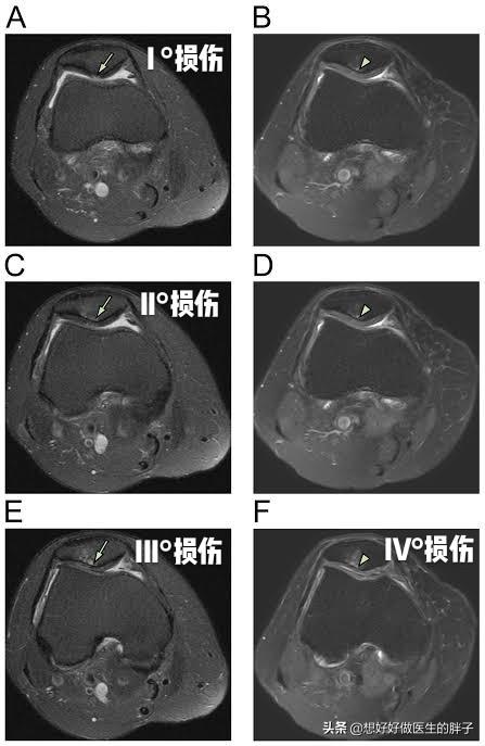 骑自行车膝关节酸是怎么回事,骑自行车时膝盖疼是怎么回事
