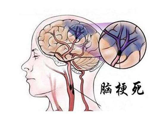 老人脑梗后双腿无力怎么治疗,脑梗双腿无力多久恢复正常