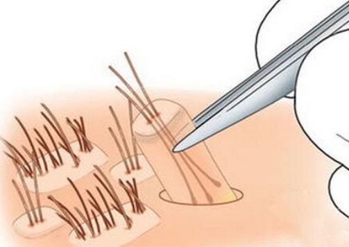 南昌第12医院植发靠谱吗,南昌植发机构的毛囊从哪来