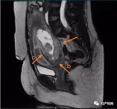 介入手术后胎盘植入还会大出血吗,胎盘植入子宫介入栓塞术3d演示