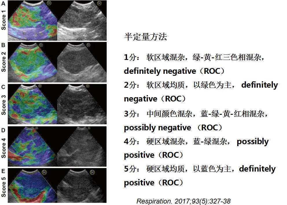 全球对肺癌治疗的最有效最新技术,肺癌的支气管镜介入治疗