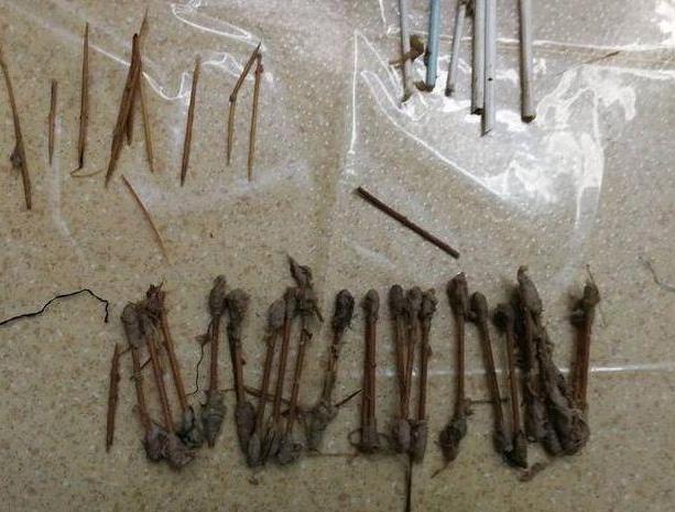 四岁小男孩切除150cm小肠,小孩子吃完饭剧烈运动急性肠梗阻