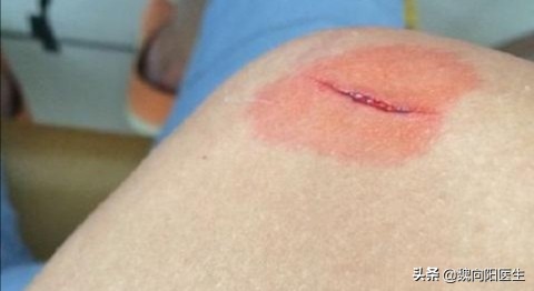 伤口碰到鸡屎会感染破伤风吗,刀割的伤口会感染破伤风吗