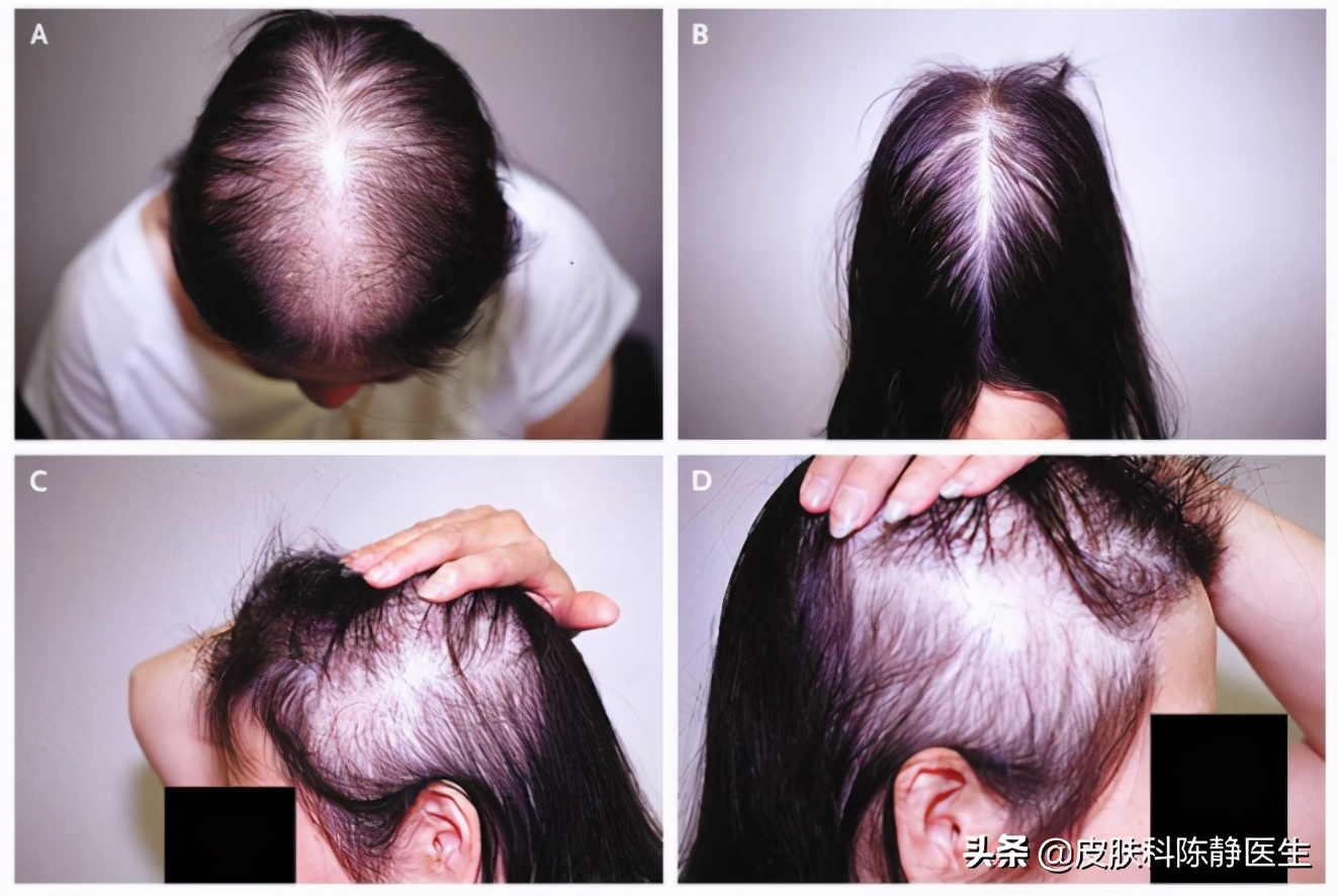 脱发最新研究成果与最新治疗方法,女性脱发严重怎么治疗才有效