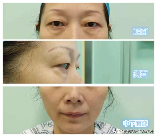 做眼袋提眉法令纹深了,上眼皮的皱纹提眉可以解决吗