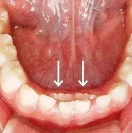 疫情期间孩子蛀牙了怎么办,疫情期间小孩牙病怎么治