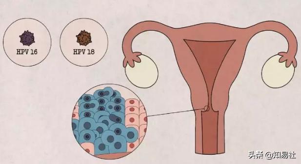 羞羞后警惕HPV感染，一不小心会得宫颈癌