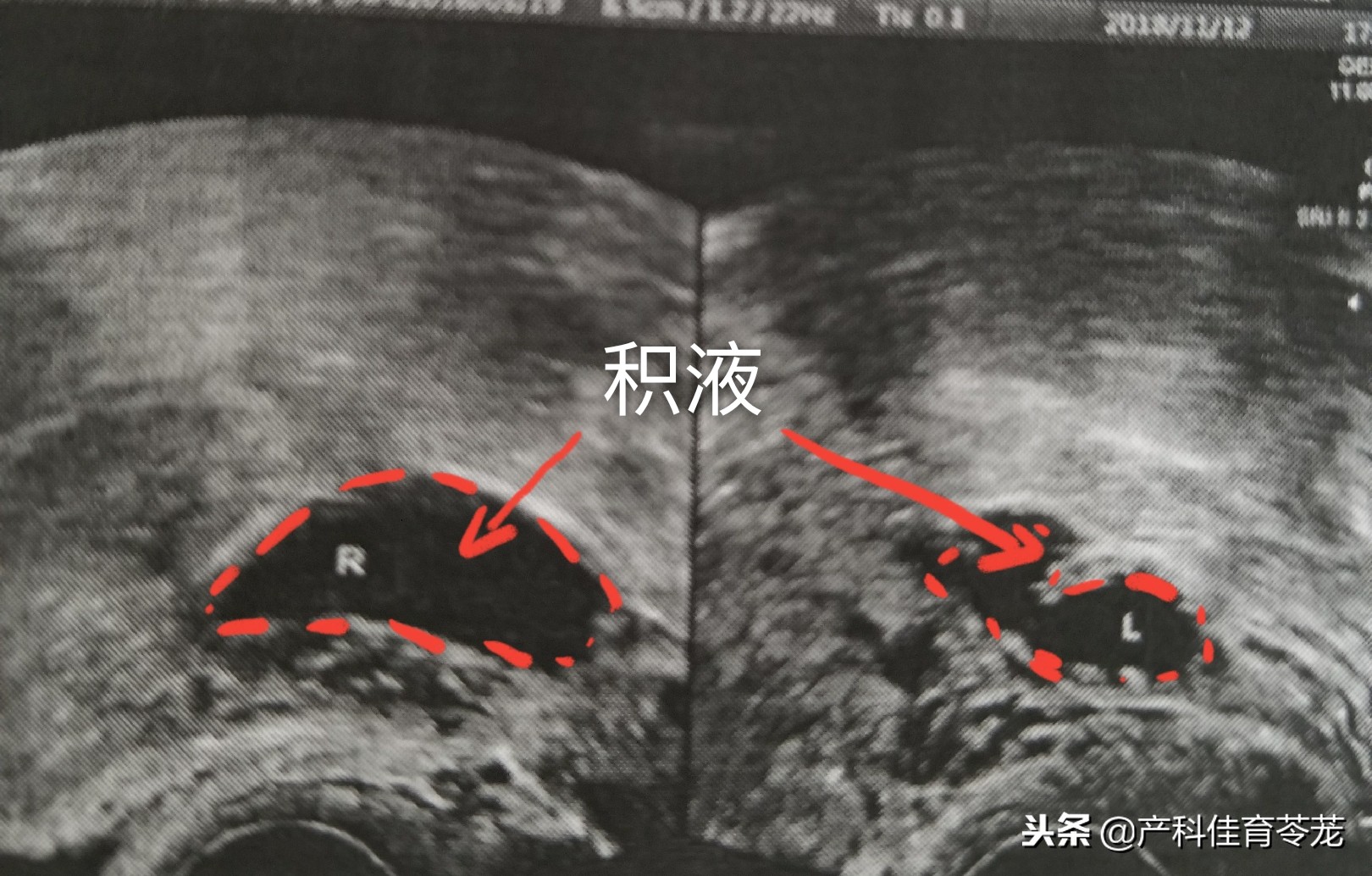 妇科b超报告单解析,妇科b超报告单几个月有效