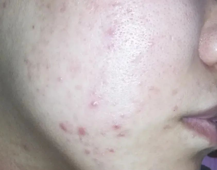 祛痘印最简单有效的方法是什么,痘印怎么去除最简单方法