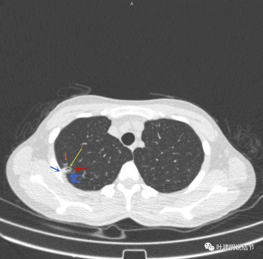临床诊断孤立性肺结节,空洞型结节一般是什么性质